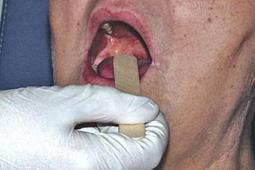 Holzmundspatel für Kinder unsteril, 100 Stk.